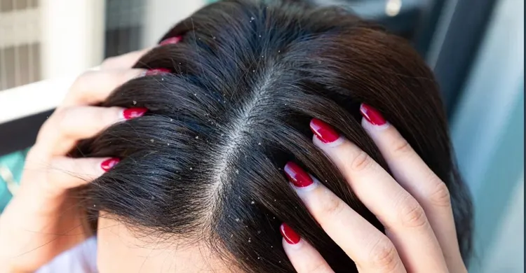 শীতের শুরুতেই খুশকির সমস্যা: ভেঙে নাও ভুল ধারণা ও জানো সঠিক কারণ