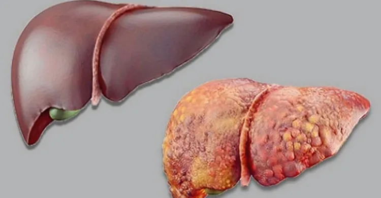ফ্যাটি লিভার কমাতে সহায়ক ৩ প্রাকৃতিক পানীয়