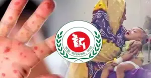 হাম ও হামের উপসর্গে আরও ৭ শিশুর মৃত্যু