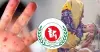 হাম ও হামের উপসর্গে আরও ৮ শিশুর মৃত্যু