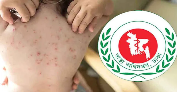 হামের উপসর্গে আরও ৩ শিশুর মৃত্যু, মোট প্রাণহানি বেড়ে ৫৮৮