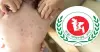 হামের উপসর্গে আরও ৩ শিশুর মৃত্যু, মোট প্রাণহানি বেড়ে ৫৮৮
