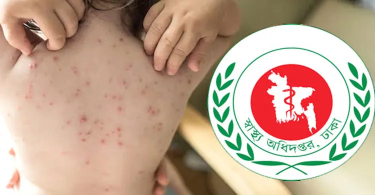 হামে আরও ৭ শিশুর মৃত্যু, ২৪ ঘণ্টায় শনাক্ত ৮৮৭ নতুন রোগী