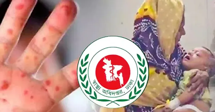 গত ২৪ ঘণ্টায় হাম ও উপসর্গে আরও ৭ জনের মৃত্যু