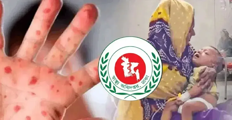 হাম ও উপসর্গে আরও ৮ শিশুর মৃত্যু, হাসপাতালে ভর্তি ১,১৭১