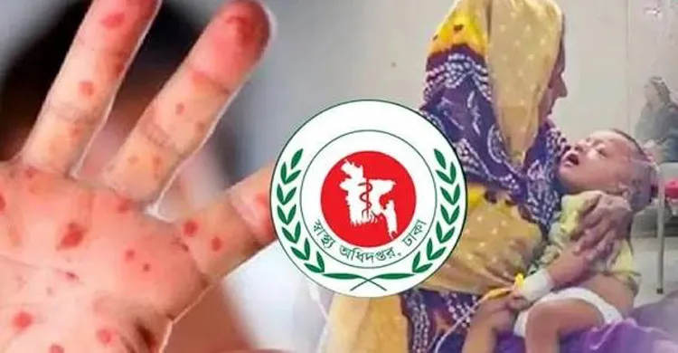হামের উপসর্গে আরও ৪ শিশুর মৃত্যু, প্রাণহানি বেড়ে ৮৩৫