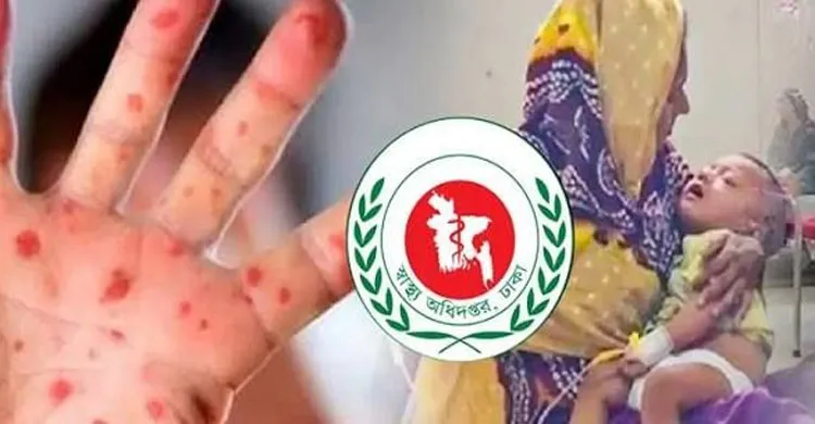 হাম উপসর্গে আরও ৬ জনের মৃত্যু