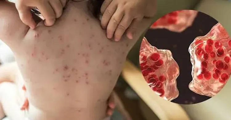 হামের উপসর্গে ২৪ ঘণ্টায় আরও ৫ শিশুর মৃত্যু