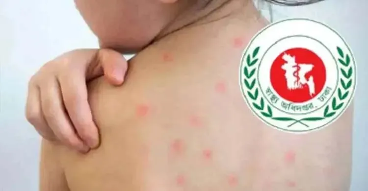 হাম উপসর্গে আরো ৬ জনের মৃত্যু, আক্রান্ত ১৪৬৬